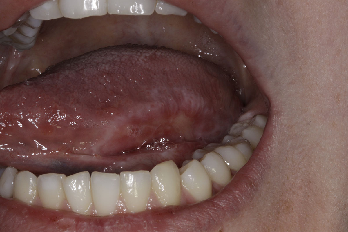 Oral Lichen Planus Lesions